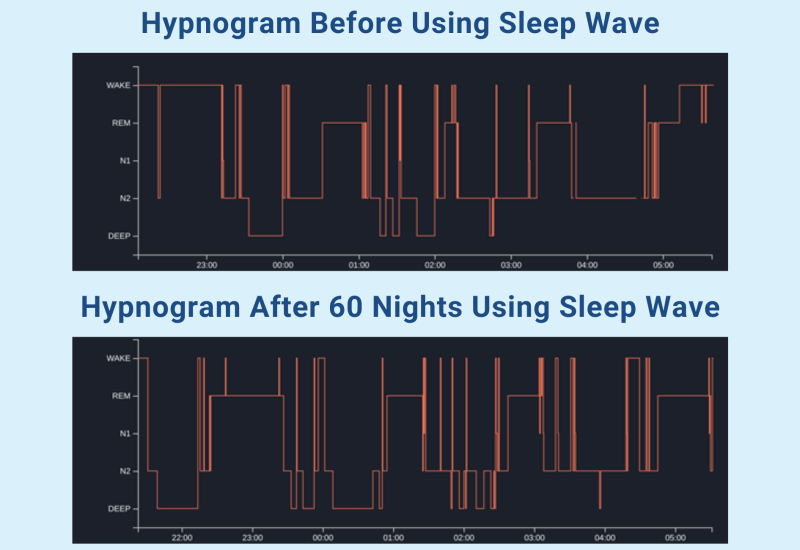 Hypnogram Comparison Before and After Sleep Wave use